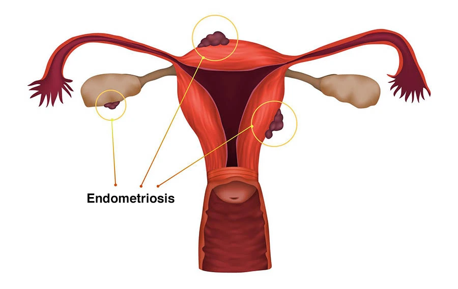 Genix Fertility Care | Problems for Periods in Bhubaneswar, Odisha >> IUI