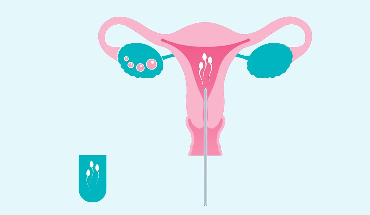 Genix Fertility Care | Cost of infertility treatment
                                                 in Bhubaneswar, Odisha >> Female partners with 'hostile' cervical mucous